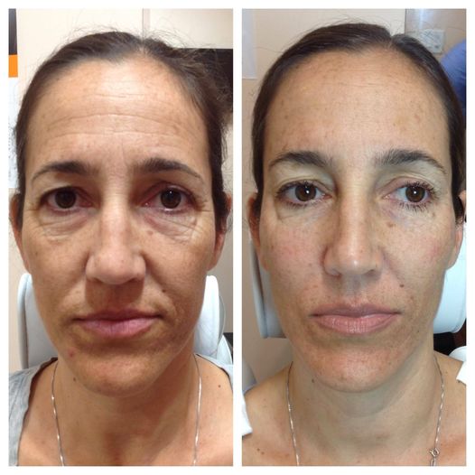 SRC-7 Skin Renewal Duo